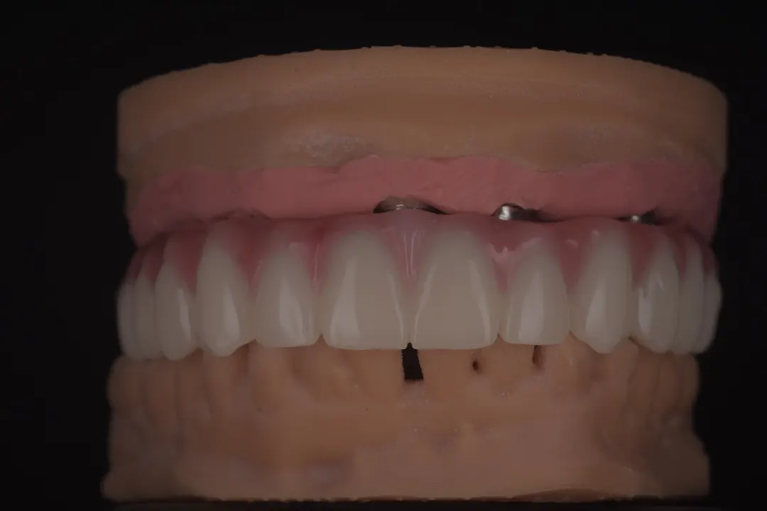 Proteze provizorii pe Implant