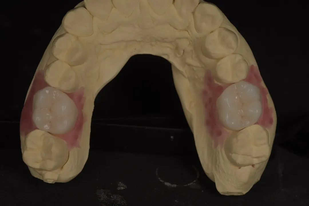 Zirconiu Full Anatomic
